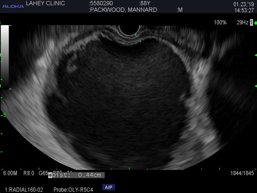 B. EUS of walled off peripancreatic fluid collection