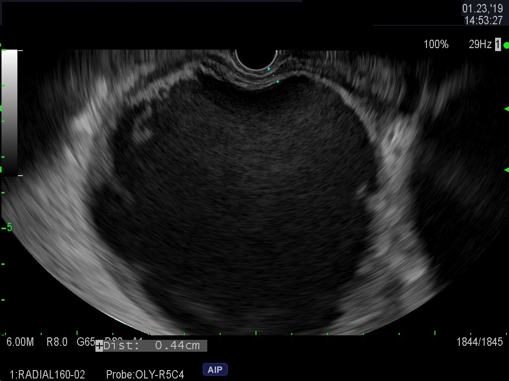 B. EUS of walled off peripancreatic fluid collection